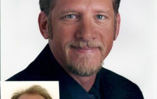 before and after Hair transplant Patient Testimonials