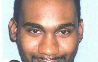 before and after Hair transplant Patient Testimonials